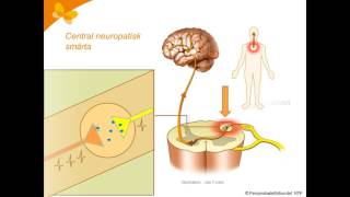 5 neuropatisk smärta [upl. by Cheria]