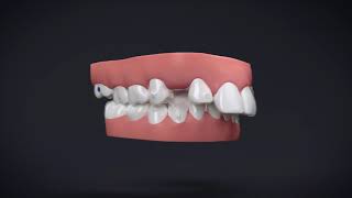 Invisalign® Treatment with Manidublar Advancement [upl. by Maril]