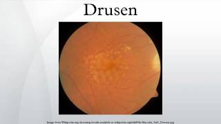 Drusen [upl. by Eicyaj]