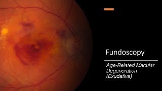 How Macular Degeneration Causes Vision Loss  WebMD [upl. by Nauqyt]