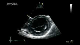 DYSKINETIC SEPTUM DEFORMATION MAY HELP [upl. by Razid54]