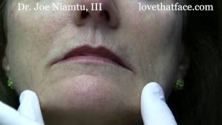 Botox Injection to DAO corner of mouth by Dr Joe Niamtu III [upl. by Ahsote]