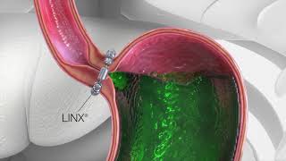 LINX Reflux Surgery Animation [upl. by Ayrb]