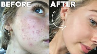 How I Cleared My Skin In 8 Weeks naturally [upl. by Bagley]