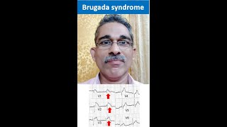 Brugada  ECG to Diagnosis [upl. by Evers]