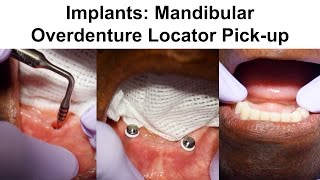 2 Implants Mandibular Overdenture Locator Pickup [upl. by Sheela]