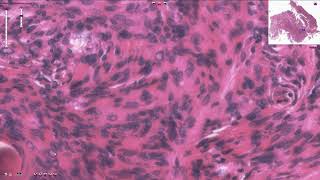 Meningioma  Histopathology [upl. by Osber]