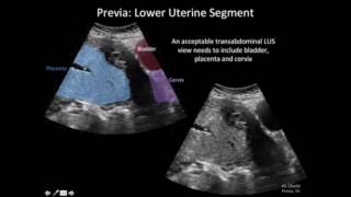 Ultrasound Diagnosis of Placenta Accreta A Tutorial for Imagers [upl. by Ellord]