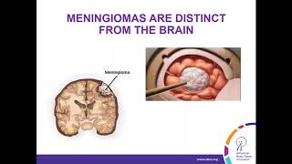 WEBINAR Treatment Strategies for Meningioma [upl. by Fernando]