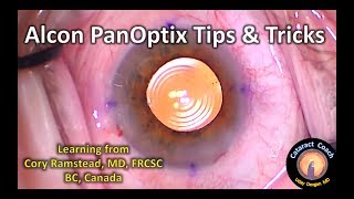 Alcon PanOptix Trifocal IOL Tips amp Tricks for Cataract Surgery [upl. by Annavoig639]