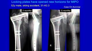 Complex Proximal Femur Fractures [upl. by Ahsitak800]