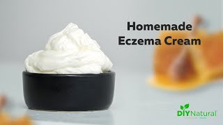 DIY Eczema Cream A Homemade Natural Solution That Works [upl. by Leirbag]