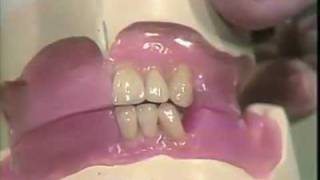 Setting Mandibular Anterior Teeth [upl. by Lavelle]