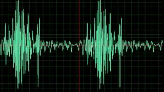 NORMAL CAROTID COLOR DOPPLER [upl. by Maggie292]