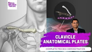 Clavicle Anatomical Plates Fixation Procedure [upl. by Nylkoorb]