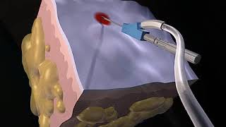 How Liposuction Works Animation  Liposuction Procedure Video [upl. by Nonrev]