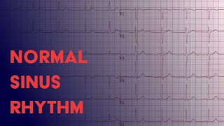 Normal Sinus Rhythm  EKG ECG Interpretation [upl. by Zinnes51]