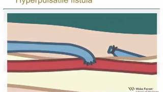 Physical Examination of Arteriovenous Fistula [upl. by Iroj591]