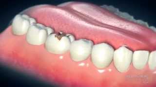 Dental Crowns Everything You Need to Know [upl. by Aidua]