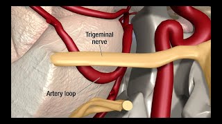 Multiple Sclerosis Pain Explained Trigeminal Neuralgia [upl. by Salesin799]