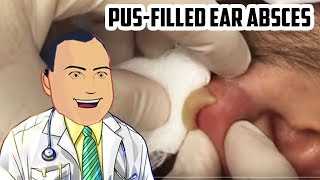 PusFilled Ear Abscess Drained  Revisited Popping [upl. by Annibo2]