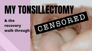 MY TONSILLECTOMY Daybyday recovery walkthrough [upl. by Puklich]