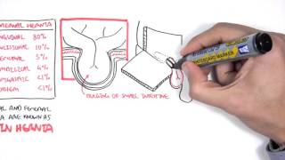 Introduction to Direct and Indirect Inguinal Hernia [upl. by Neelra401]