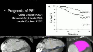 Pulmonary embolism echo in all [upl. by Elirpa]