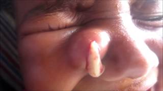 Abscess On Side Of Nose [upl. by Uni12]