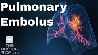 Pulmonary Embolus Nursing Care [upl. by Berg566]