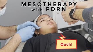 PDRN Mesotherapy AKA Biorejuvination 100 needles in my face skincare [upl. by Denman]