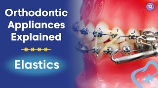 Orthodontic Appliances Explained  Elastics [upl. by Eitsirk506]