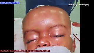 Chapter 1 Infant Repositioning for Plagiocephaly and Brachycephaly Flat Head Syndrome [upl. by Acinot]