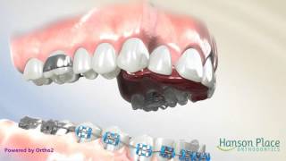 How a Fixed Bite Plate Works [upl. by Derfliw858]