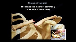 Clavicle Fractures  Everything You Need To Know  Dr Nabil Ebraheim [upl. by Cozmo255]