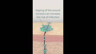 Staph infection drainage part 5 [upl. by Nilerual]