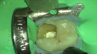 Simple Technique for PreEndodontic Restoration [upl. by Laertnom]