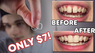 How I Closed The Gap In My Teeth In LESS THAN 1 WEEK DIY Budget Braces  Gap Bands [upl. by Nnyltiac]