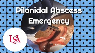 Pilonidal Abscess Emergency Incision amp Drainage [upl. by Monsour]