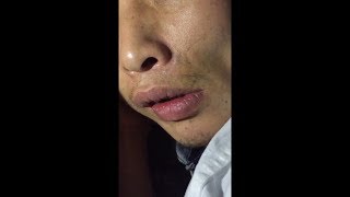 Orofacial Dyskinesia [upl. by Ennayr]