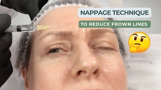 Mastering the Mesotherapy Nappage Method [upl. by Alejoa]