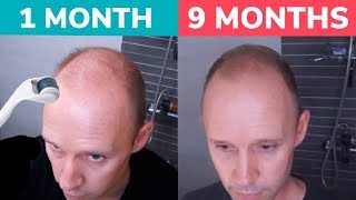 STOP BALDING  Regrow Hair Naturally with Dermaroller Real 9 Month Results [upl. by Bunny]