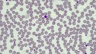 WBC Differential WBCPLT Estimate RBC Morphology [upl. by Yrgoerg814]