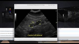 How to Find Those Difficult Adrenal Glands [upl. by Linell]