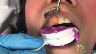 Cosmetic Dental Crown Procedure  All Ceramic Crown [upl. by Jenifer978]