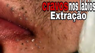 🔴Removendo CRAVOS dos labiosSATISFATÓRIO  cravos na boca 😮 [upl. by Yraillih287]